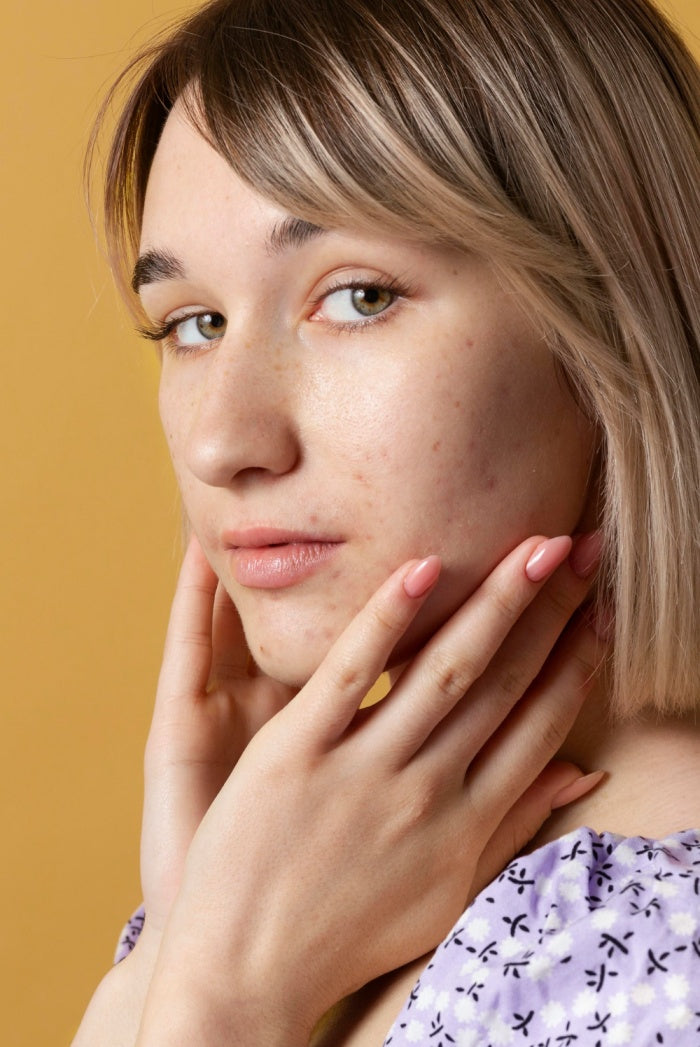 Acne Treatment / Tratamento para Acne
