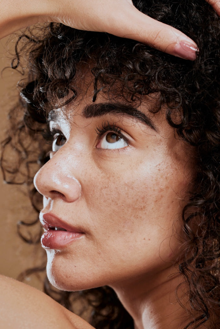 Melasma Treatment / Tratamento para Melasma