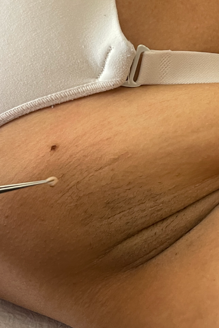 Skin Tag Removal / Remoção de verrugas
