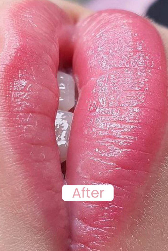 Lip’s hydration / Hidratação labial