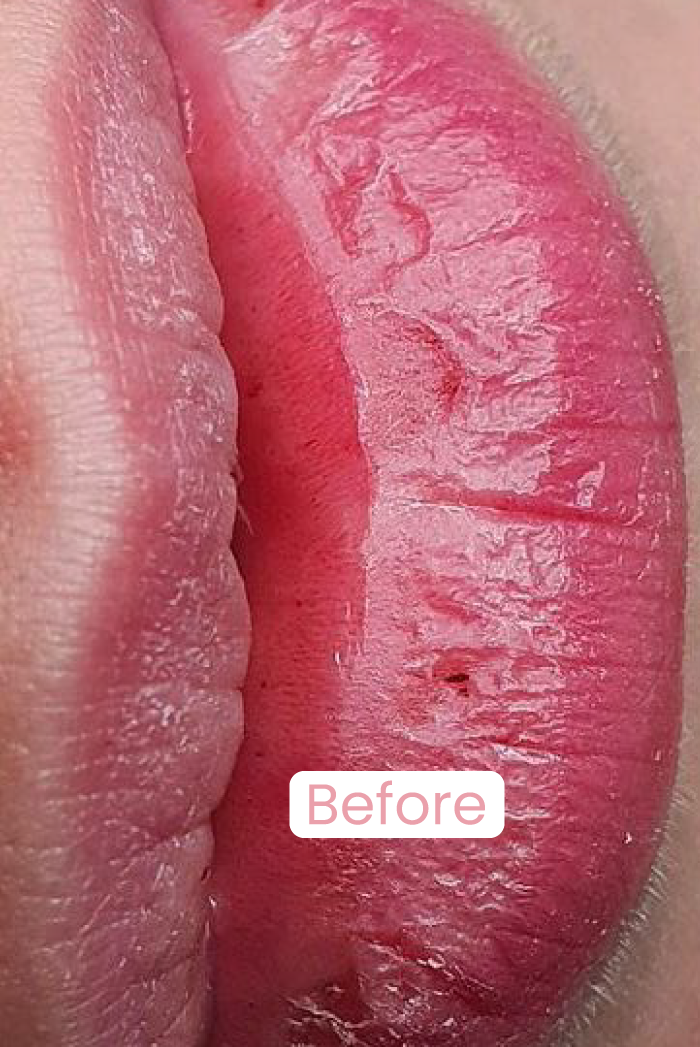 Lip’s hydration / Hidratação labial
